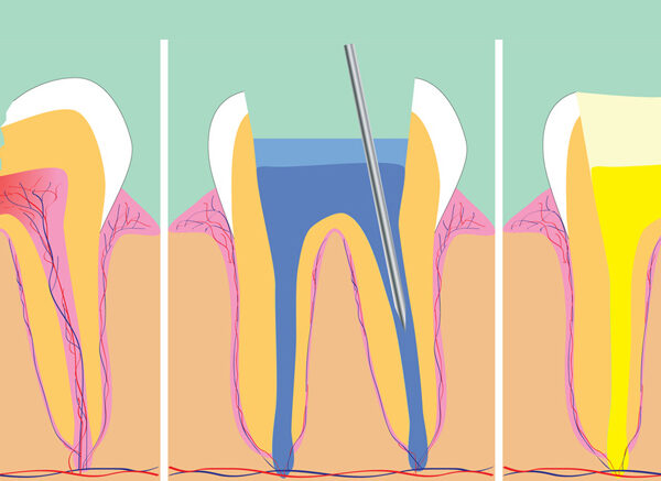 Devitalizzazione Dente