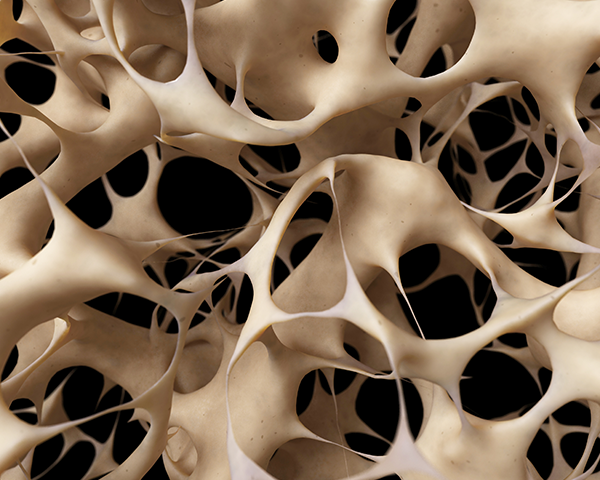 Osteoporosi