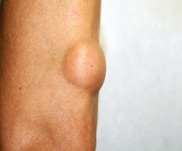 Lipoma Cause Sintomi Rimozione