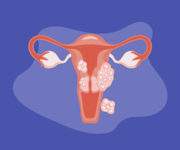 Fibromi Uterini Sintomi Cause