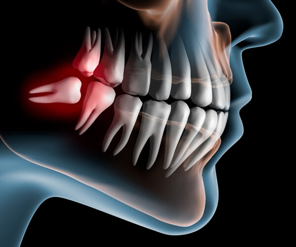 Rimozione Dente Del Giudizio